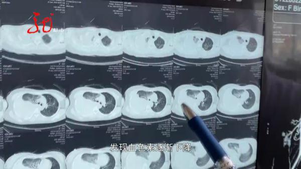 5000ml血液喷涌而出,哈尔滨一“熊猫血”女子突发血管破裂 5000ml血液喷涌而出,哈尔滨一“熊猫血”女子突发血管破裂