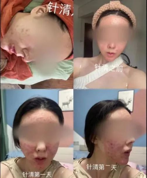 广西20岁美女祛痘不成反“烂脸 ” 要索赔！美容院：放弃治疗后果自负！