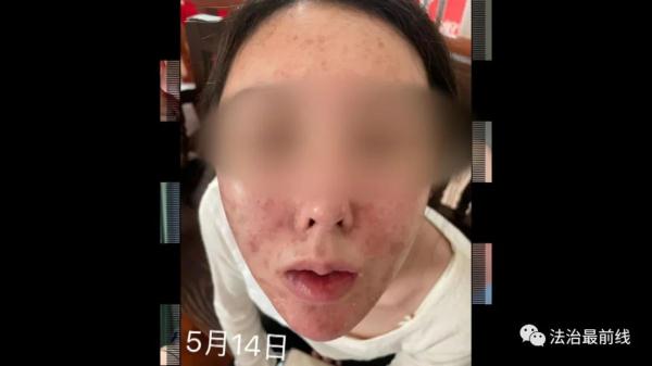 广西20岁美女祛痘不成反“烂脸 ” 要索赔！美容院：放弃治疗后果自负！