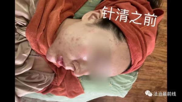 广西20岁美女祛痘不成反“烂脸 ” 要索赔！美容院：放弃治疗后果自负！