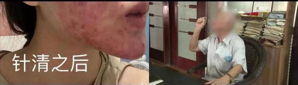 广西20岁美女祛痘不成反“烂脸 ” 要索赔！美容院：放弃治疗后果自负！