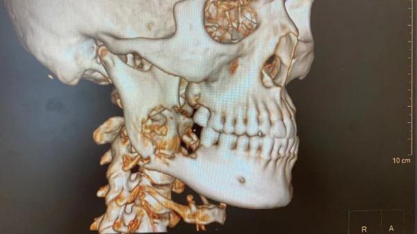 拔智齿却发现癌？浙江男子懵了……专家：嘴巴给你的这些提醒，别忽视！