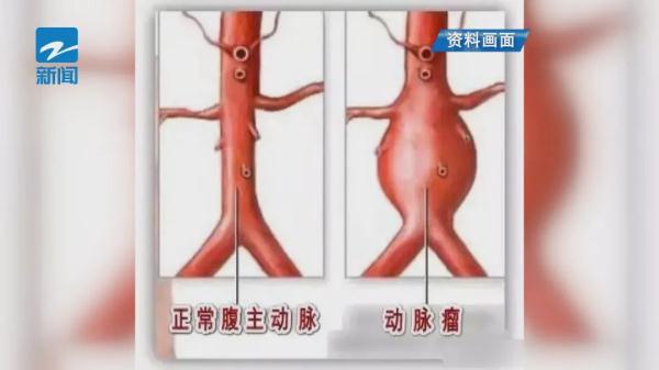 大伯就医意外发现肾脏的“秘密”，从医三十年的医生大呼：第一次见！