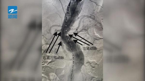 大伯就医意外发现肾脏的“秘密”，从医三十年的医生大呼：第一次见！