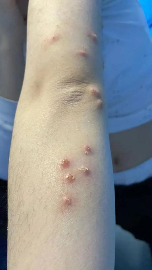 虫咬性荨麻疹怎么解决图片