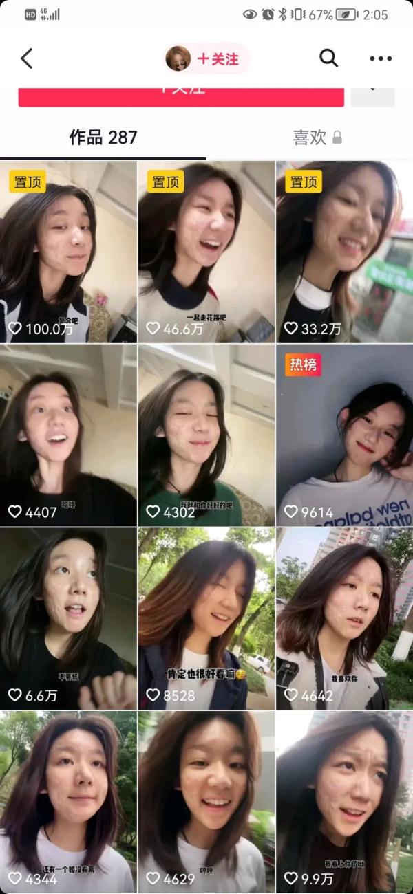 成为自己的太阳 重庆女孩面部烧伤后用笑容治愈网友