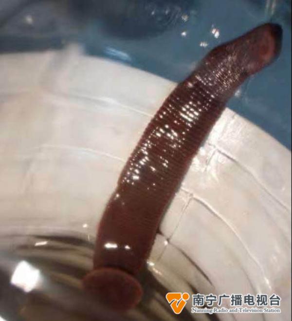 7厘米蚂蟥“寄居”男子鼻腔半个月！取出时仍在蠕动......
