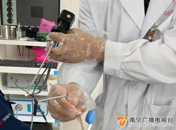 7厘米蚂蟥“寄居”男子鼻腔半个月！取出时仍在蠕动......