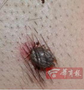 重要提醒！西安市民周末露营后，孩子头上的“黑痣”突然长大了，一查竟是……