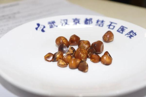 1300多颗结石搞坏老太胆囊，医生：来得太晚了！