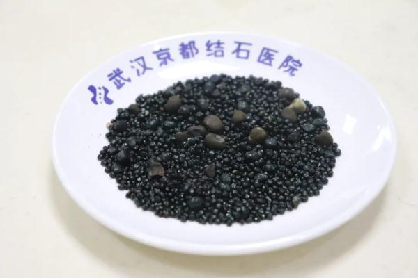 1300多颗结石搞坏老太胆囊，医生：来得太晚了！