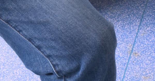 女子为减肥每天跳绳4千下，结果跳进了手术室