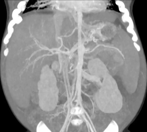 为爱减重近20斤！广东一39岁爸爸“割肝救女”