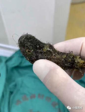 佛山5岁女孩腹痛难忍，医生一查胃镜瞬间惊了：胃内全是头发！