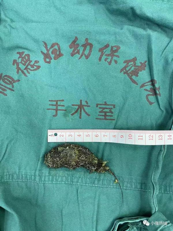 佛山5岁女孩腹痛难忍，医生一查胃镜瞬间惊了：胃内全是头发！