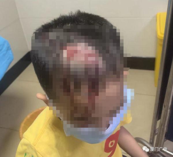 突发!厦门6岁男童被砸,头破血流!金属板从天而降......监控实拍! 突发!厦门6岁男童被砸,头破血流!金属板从天而降......监控实拍!