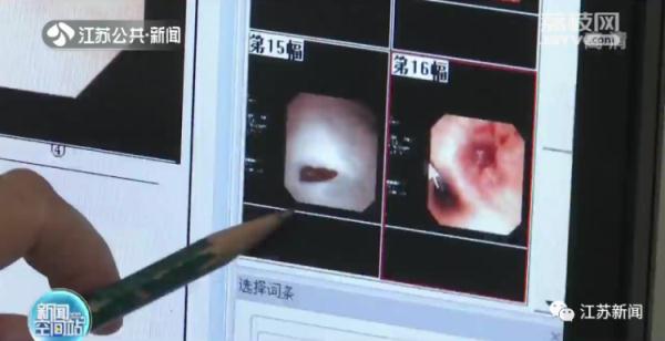 女子咳嗽一年不见好，气管里竟发现一个完整的辣椒尖！