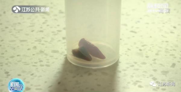 女子咳嗽一年不见好，气管里竟发现一个完整的辣椒尖！