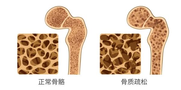 烈日炎炎，过度防晒竟成骨质疏松隐患！