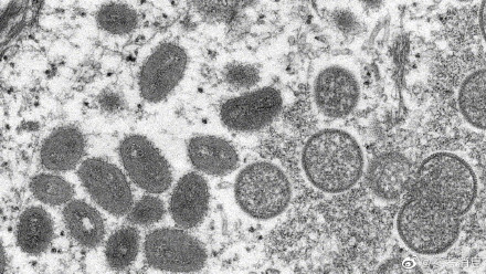 日本出现第二例猴痘病例，与此前一例无关联