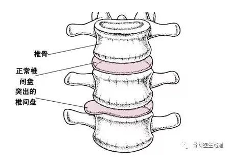 脊椎问题人人都有？腰突到底如何预防？学会这几招有奇效