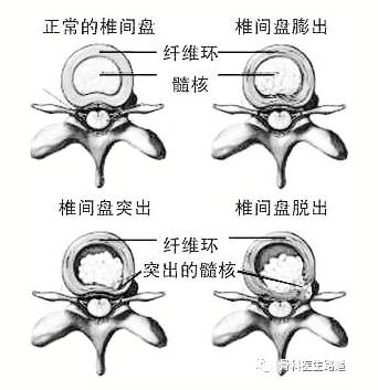 脊椎问题人人都有？腰突到底如何预防？学会这几招有奇效