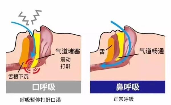 孩子睡觉“打呼噜”，未必是睡得香