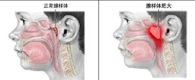 孩子睡觉“打呼噜”，未必是睡得香