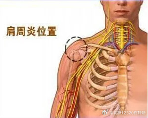 肩周炎在哪种情况下可以自行缓解?