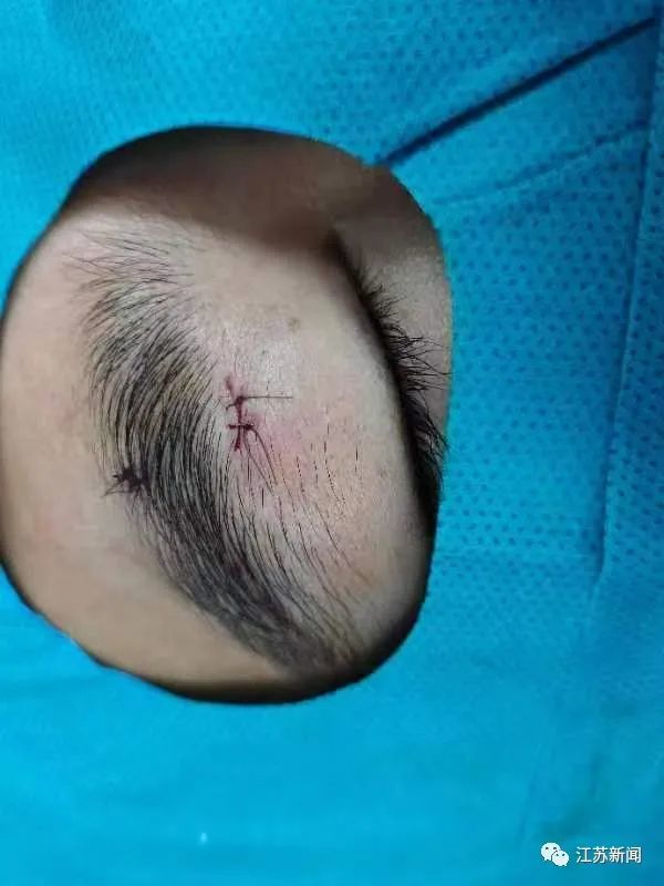 可怕！男子钓鱼却将鱼钩甩进眼睛，差点失明！医生提醒