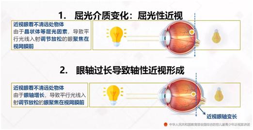 近视的主要类型有屈光性近视和眼轴过长导致的近视.