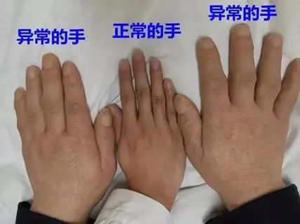 6旬阿姨相貌变得“五大三粗”，一查竟是这个原因……