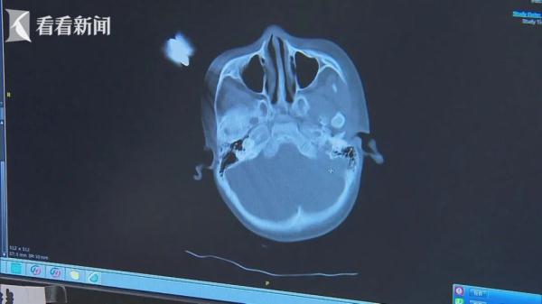 揪心！沪一5岁女童从床上跌落，剪刀插入颅内...