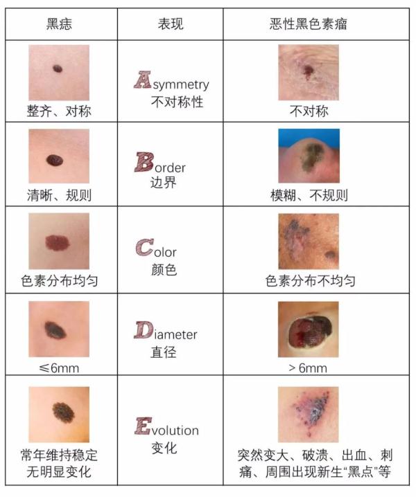 别和我起摩擦，我会变成黑色素瘤！
