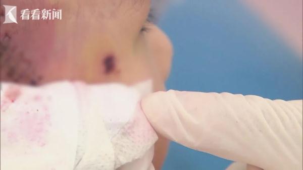 揪心！沪一5岁女童从床上跌落，剪刀插入颅内...