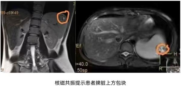 太罕见！胎儿居然长在了脾脏上 安徽一医院最新发现