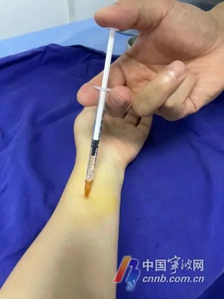 连续6天打嗝停不下来，宁波男子几近崩溃……