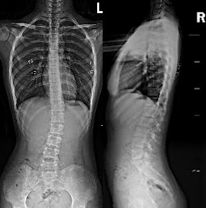 快摸摸孩子的脊柱，看看有没有侧弯！