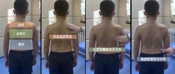 快摸摸孩子的脊柱，看看有没有侧弯！