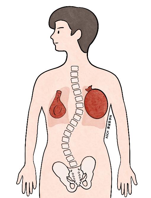 快摸摸孩子的脊柱，看看有没有侧弯！