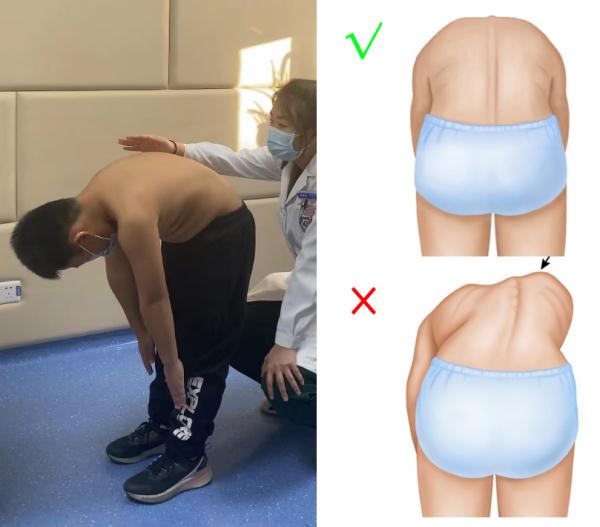 快摸摸孩子的脊柱，看看有没有侧弯！