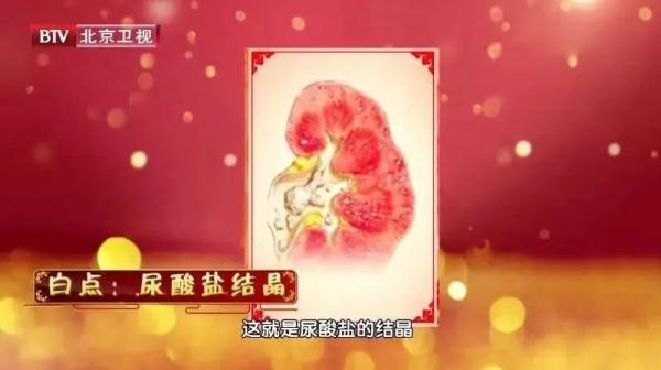 素食中的“嘌呤大户”被揪出来了!不想尿酸一涨再涨,这些事你都需要做到~ 素食中的“嘌呤大户”被揪出来了!不想尿酸一涨再涨,这些事你都需要做到~