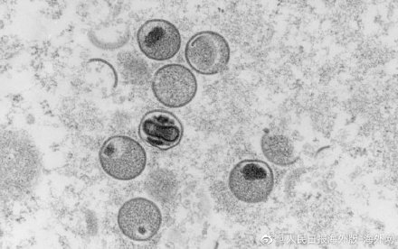 意大利男子同时感染新冠猴痘艾滋病毒 为全球首例
