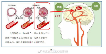 脑梗塞、脑血栓、脑栓塞的区别