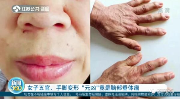警惕！女子五官变形、手脚变大，不是发福，而是得了这个病！