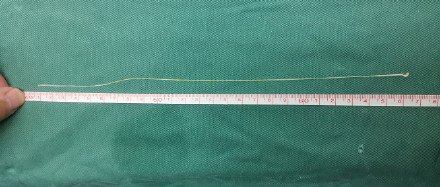 20岁女生脑袋里惊现27厘米长活虫， 医生：或与其小时候常喝生水有关