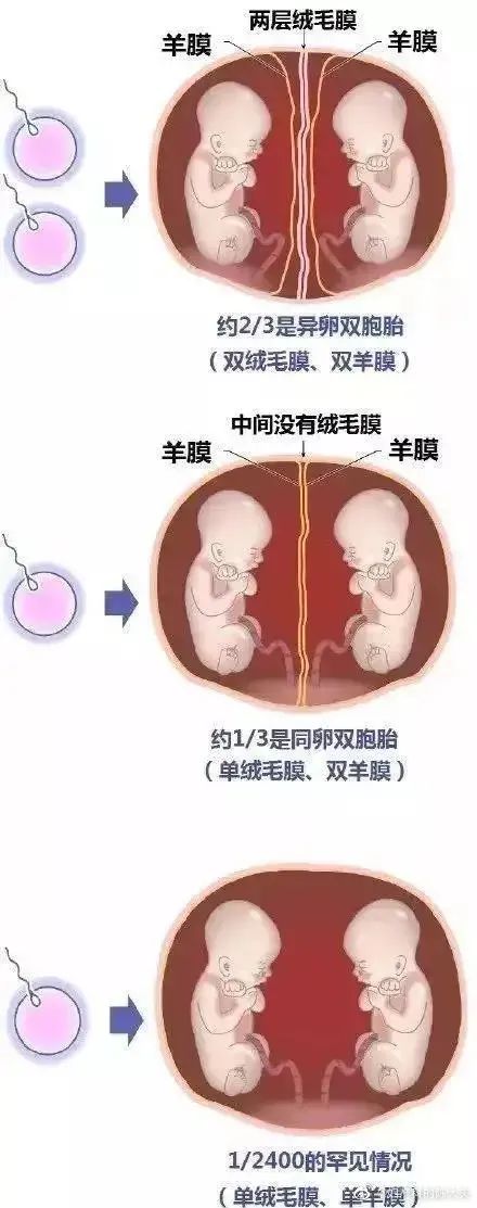 “腹中双胞胎打架，出生后浑身淤青”冲上热搜！这是真的吗？医生发声