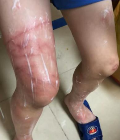 男孩在海边被水母蜇伤植皮保腿！这个错误操作千万别犯