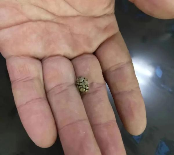 有人丢了肾,有人尿出结石,医生:出现这10个症状别大意! 有人丢了肾,有人尿出结石,医生:出现这10个症状别大意!