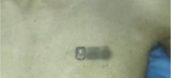 小伙胸口纹文前女友名字,去掉需手术切除!“挺后悔的,疼得刻骨铭心” 小伙胸口纹文前女友名字,去掉需手术切除!“挺后悔的,疼得刻骨铭心”